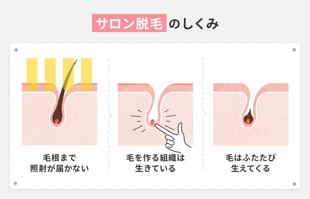 サロン脱毛の仕組み