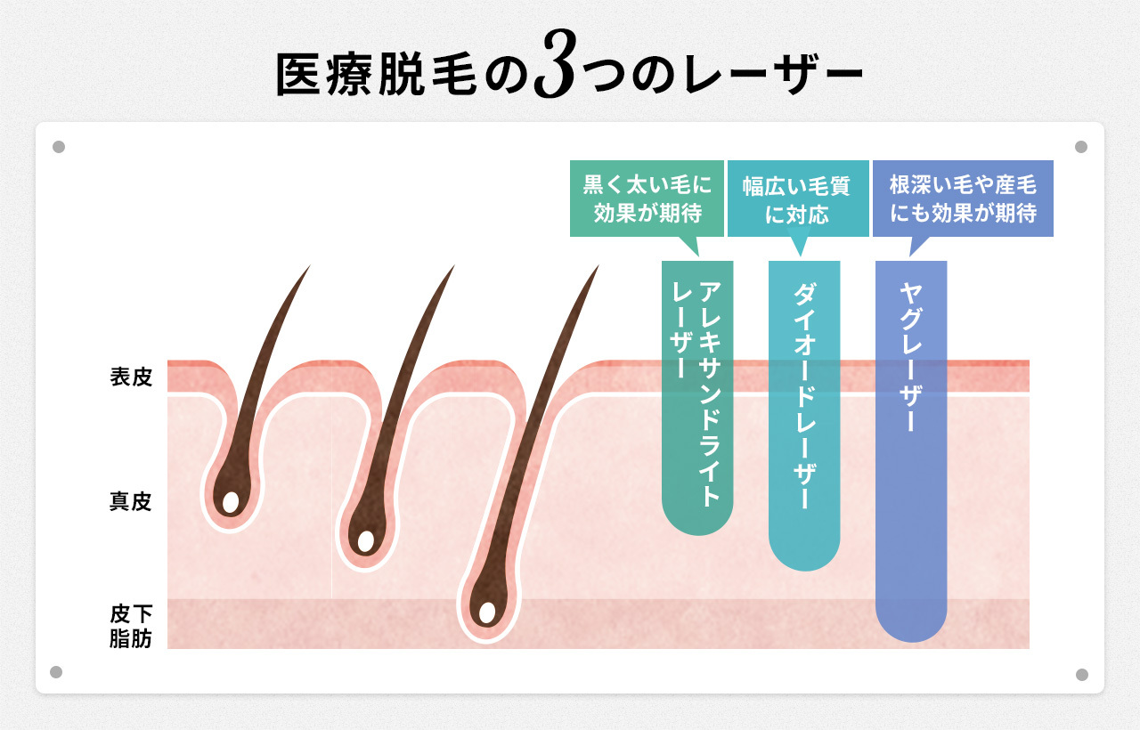 医療脱毛3つのレーザー