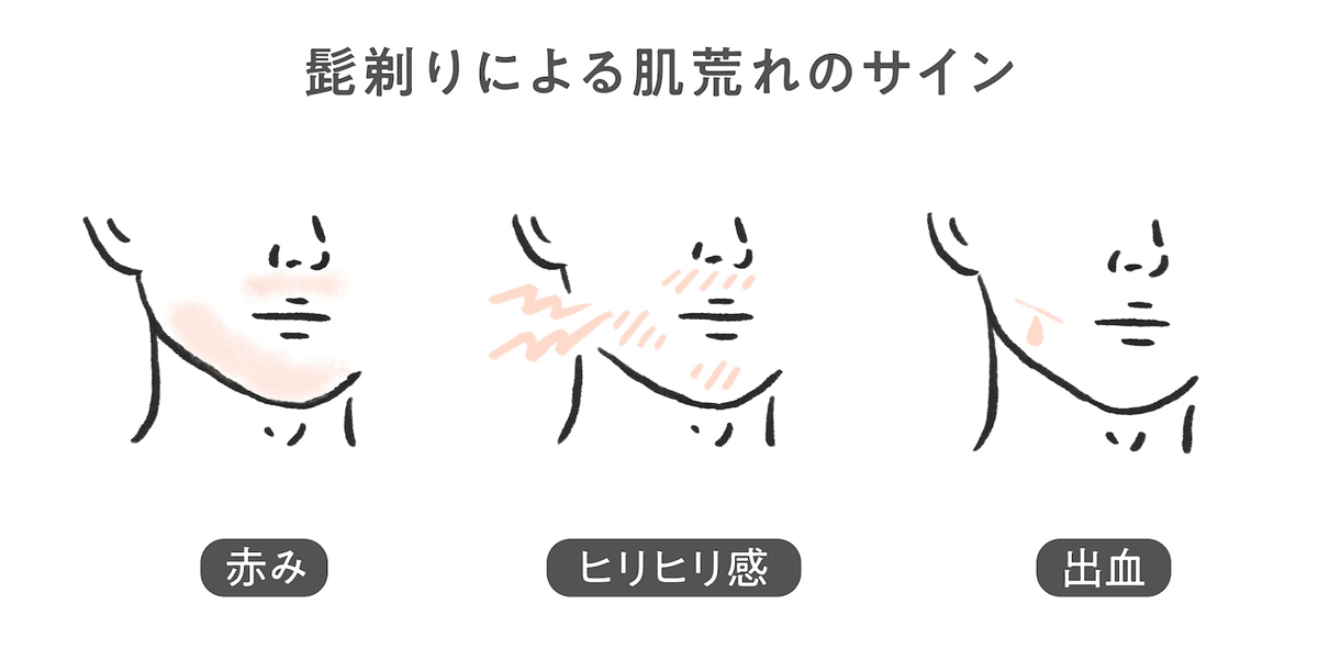 髭剃りによる肌荒れのサイン