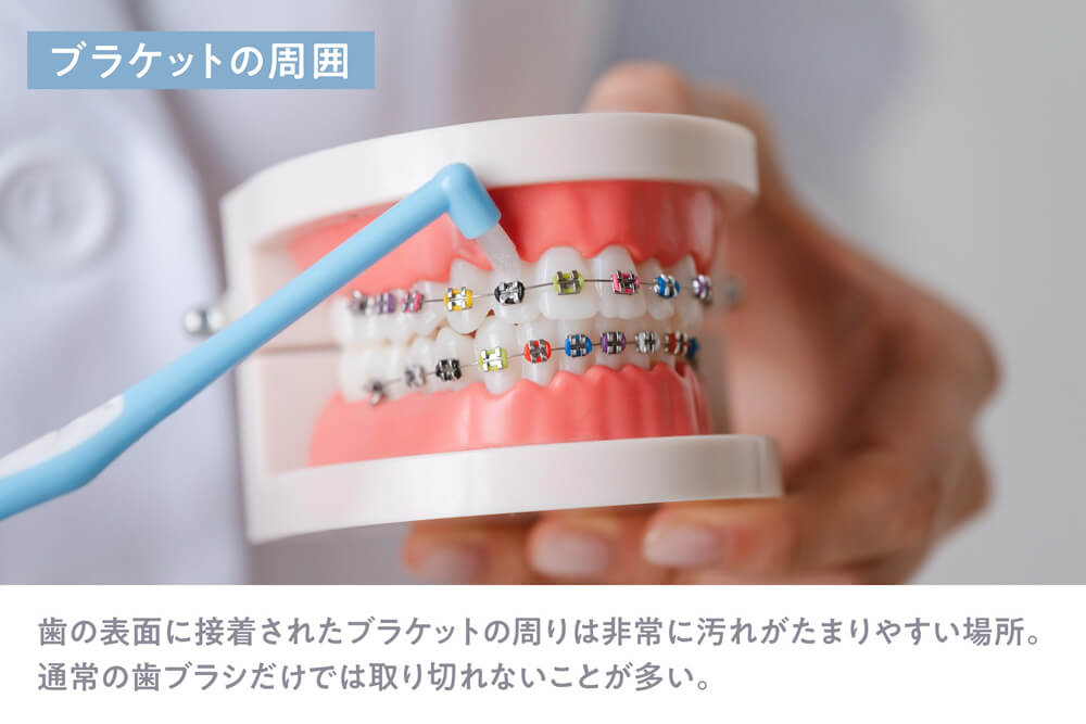 ブラケットの周囲