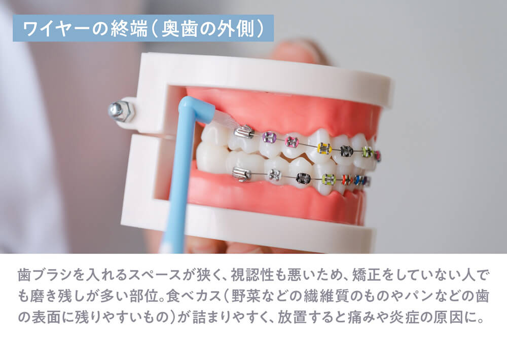 ワイヤーの終端