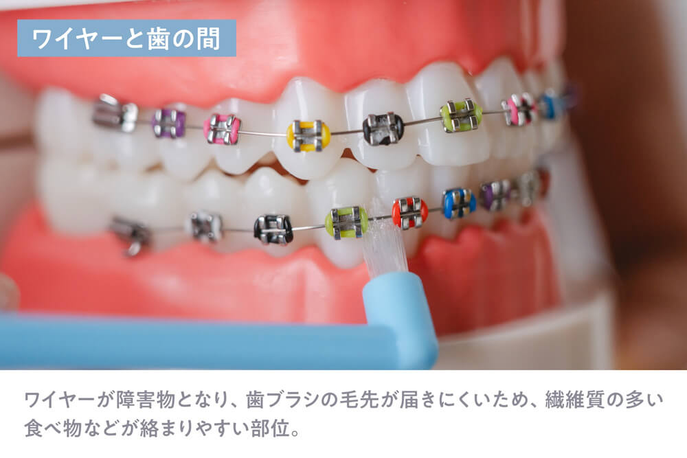 ワイヤーと歯の間