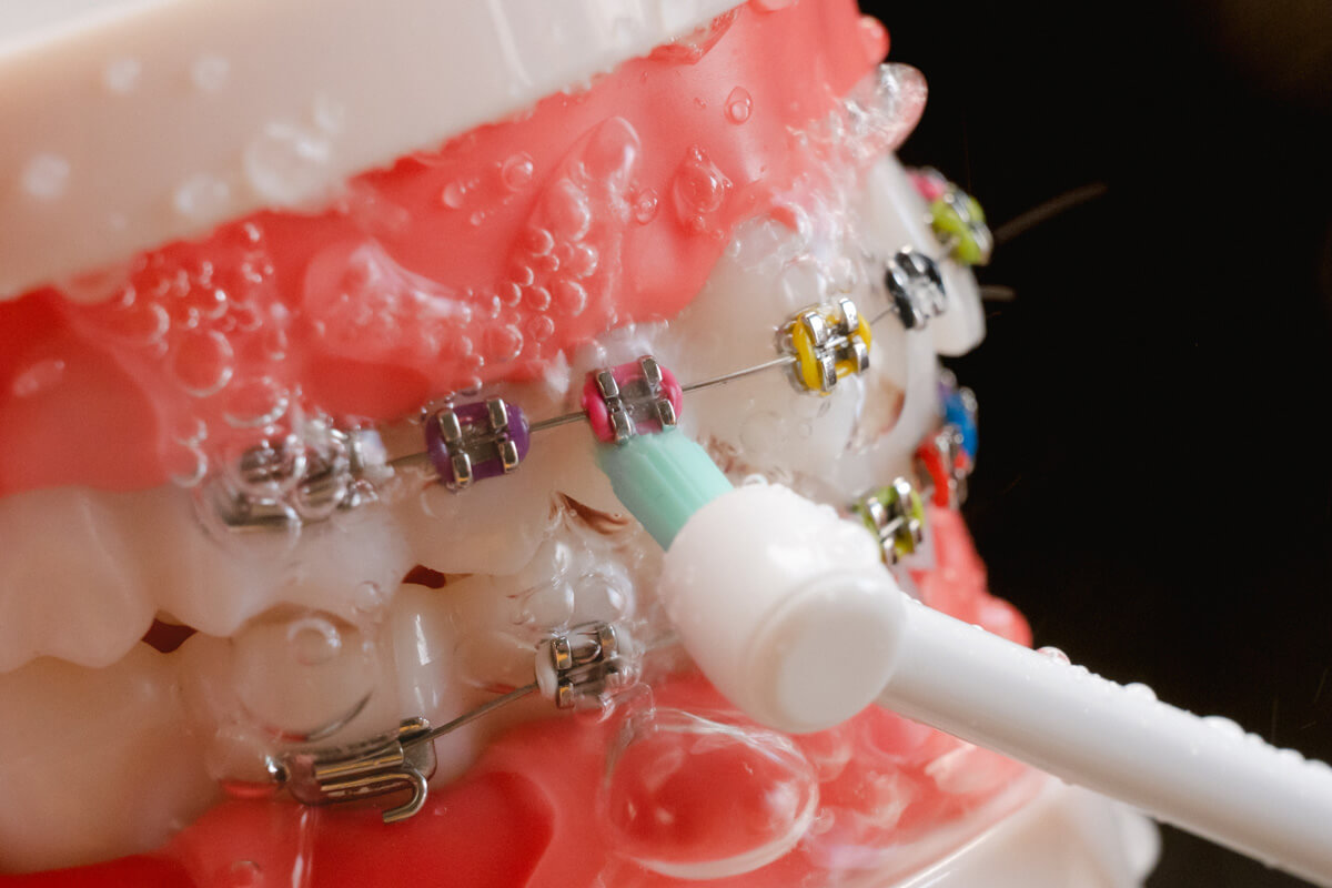 ブラケット周辺やワイヤーの下の汚れを円すい形のブラシで直接かき出しながら、同時に水流で洗い流すことができます。