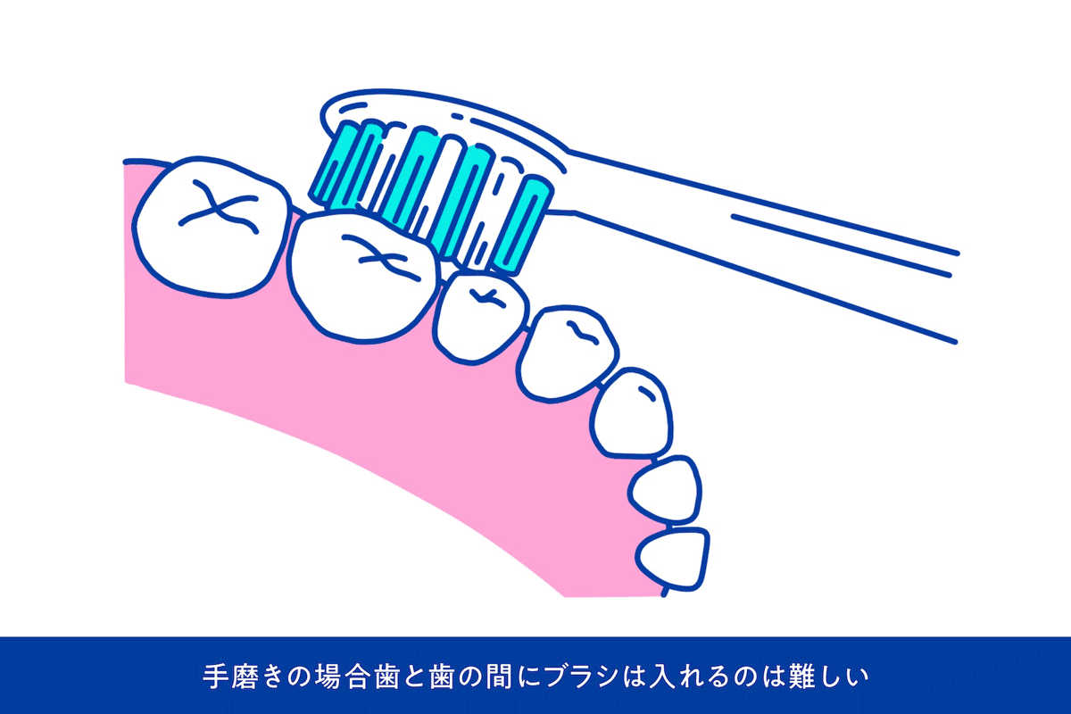 手磨きの場合歯と歯の間にブラシは入れるのは難しい