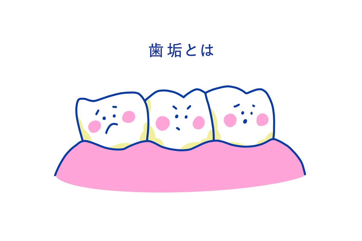 歯垢とは